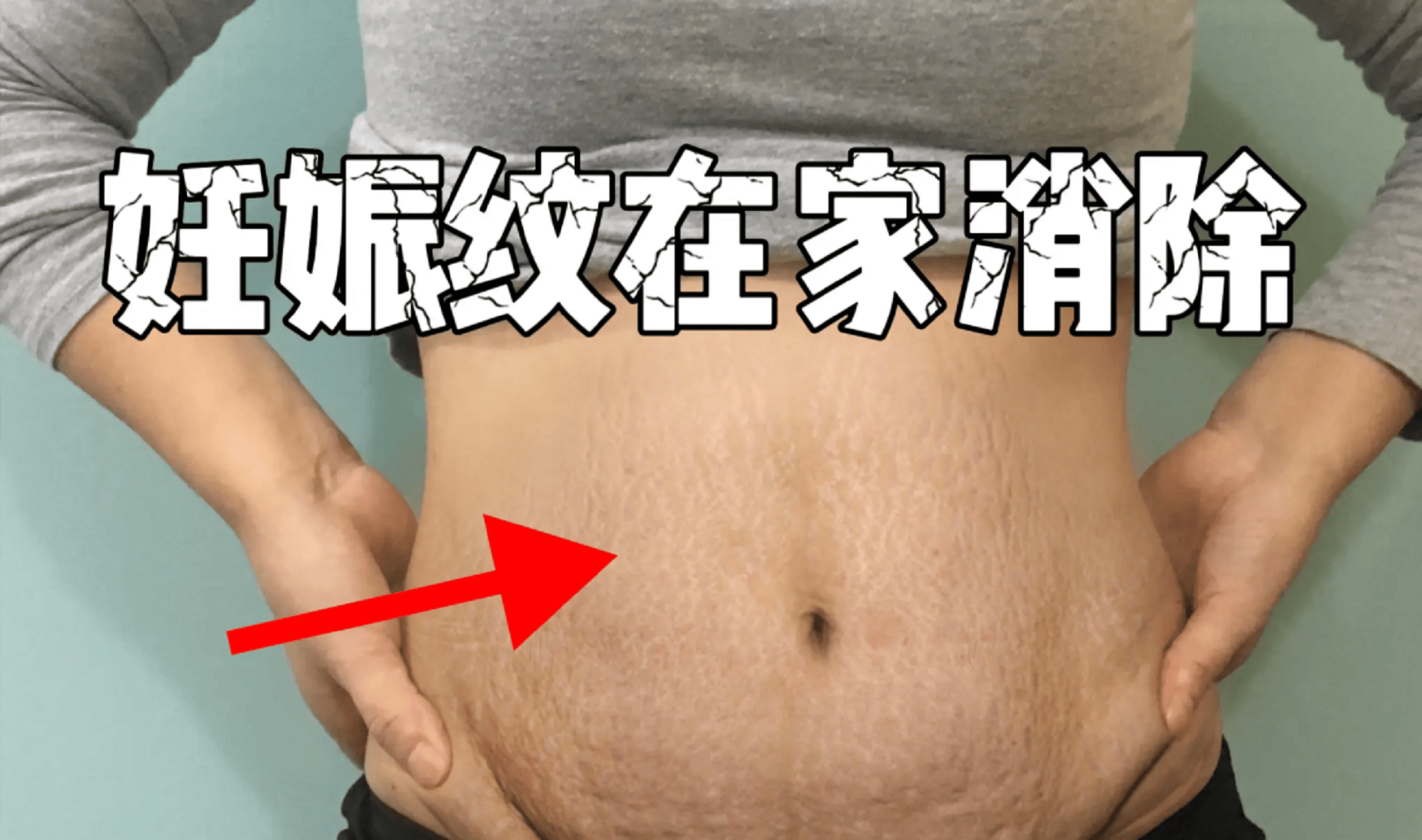 3款妊娠纹产品大测评！任用一个红白纹自己淡化消失！